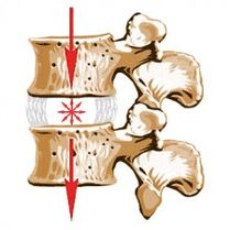 Bizkarrezurraren gailua eta osteochondrosisaren arrazoiak